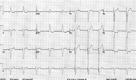 what is lvh on ecg